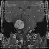 MRI of 4.6cm brain tumor successfully removed by top neurosurgeons, Dr. Derald Brackmann and Dr. Schwartz.  Contact me if faced with similar outlook - there is hope!